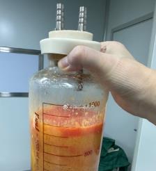 张家口水动力吸脂手术要做多久？